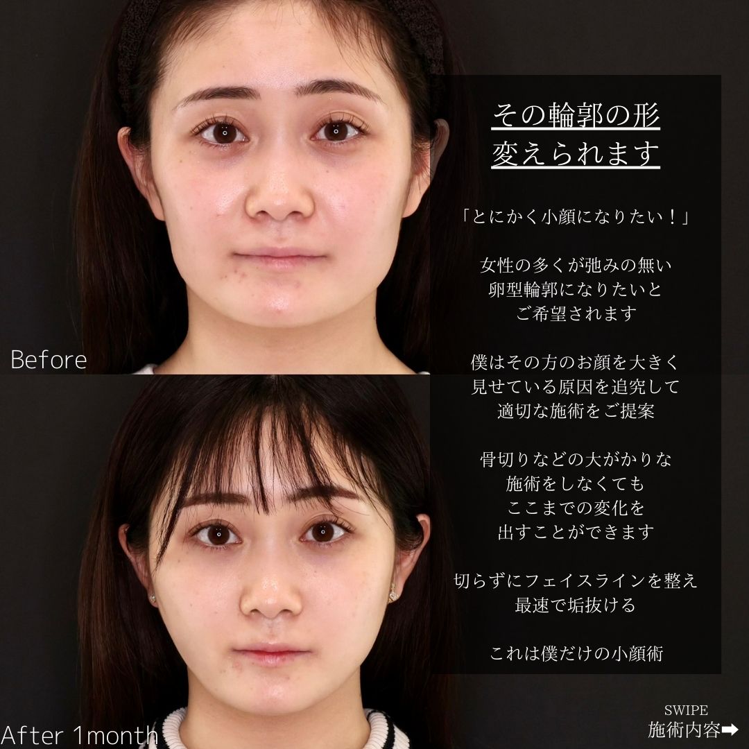 TAC式 ツヤ肌コラーゲンリフト®/ジョールファット除去/エラボトックス注射の症例写真 施術前後 