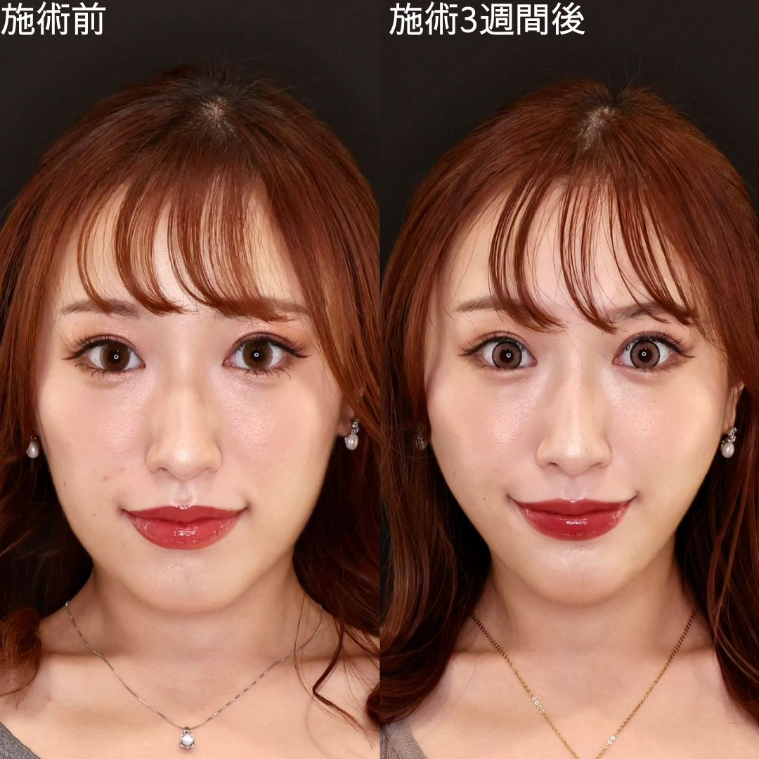 たった15分で弛み０！Dr.石橋の小顔術