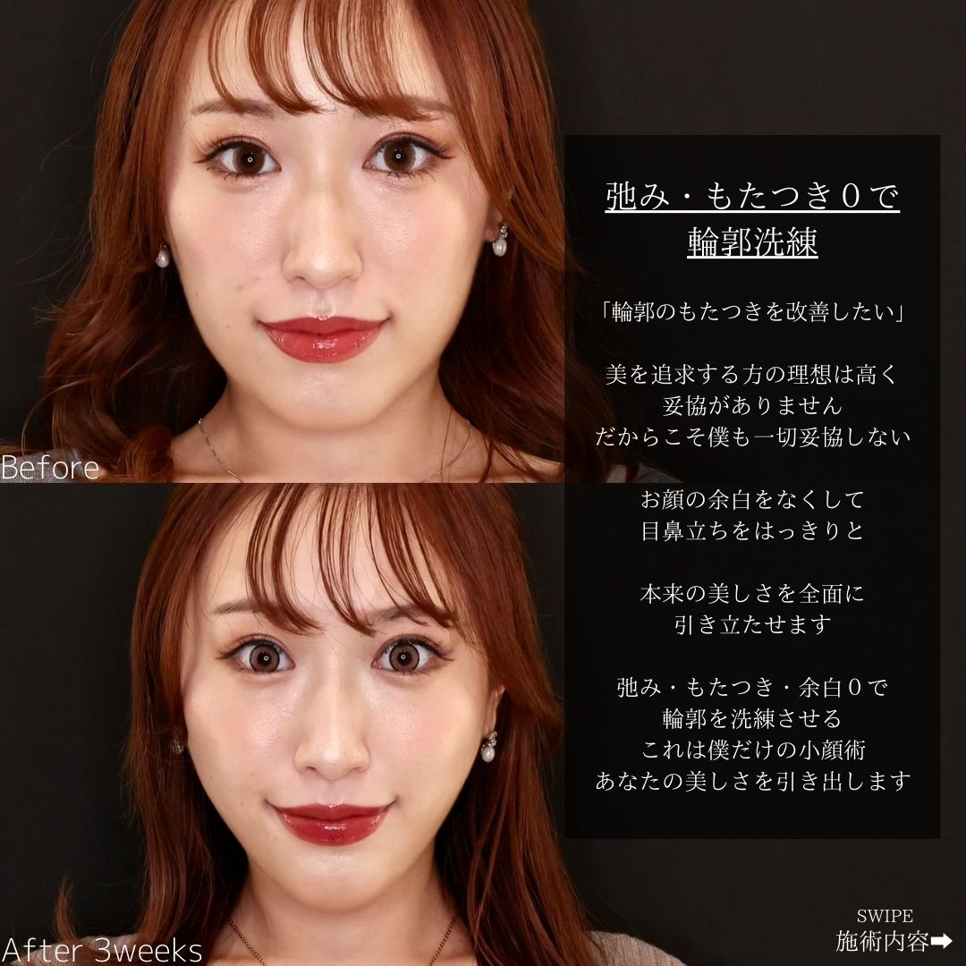 TAC式 ツヤ肌コラーゲンリフト®/ほうれい線のヒアルロン酸注射の症例写真 施術前後 