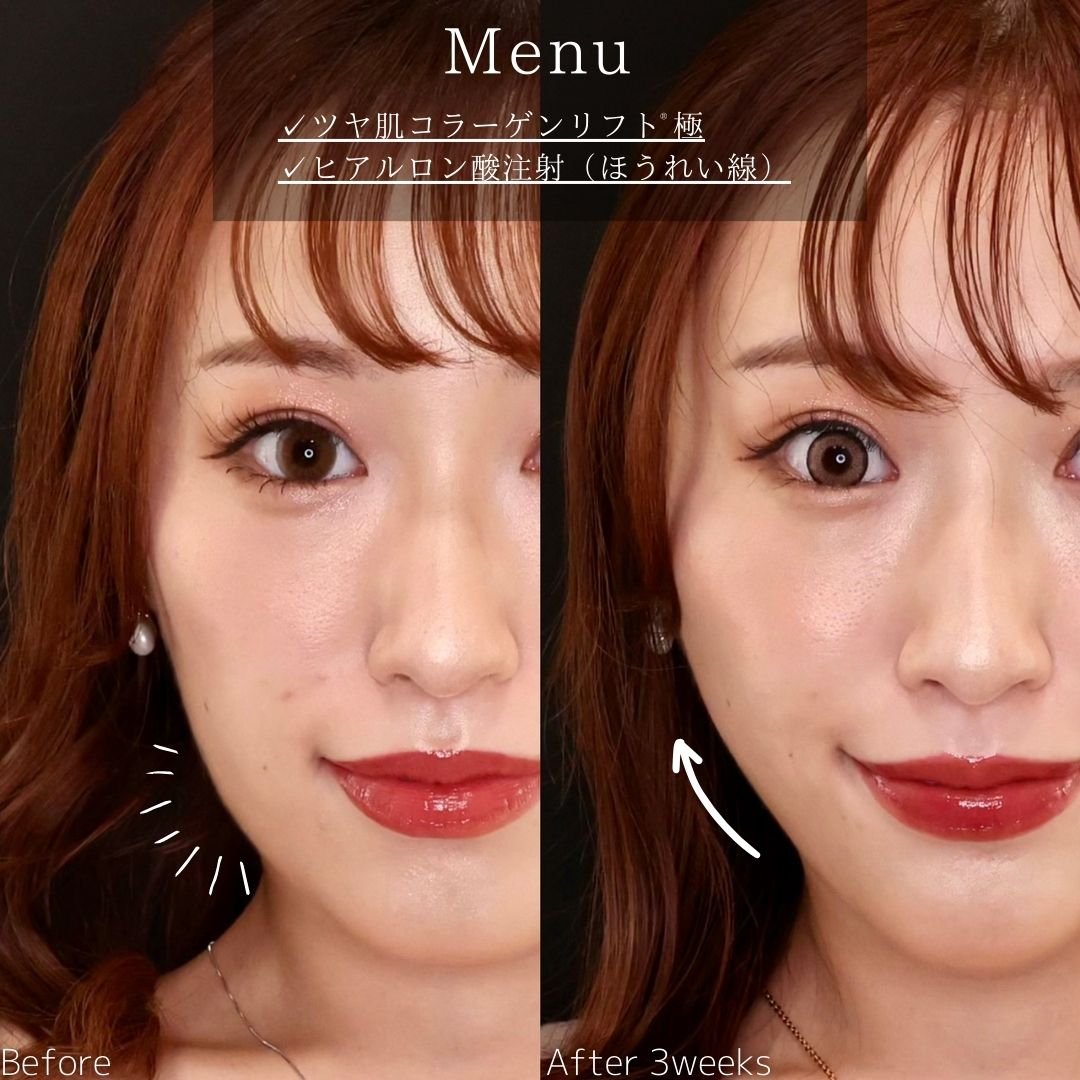 TAC式 ツヤ肌コラーゲンリフト®/ほうれい線のヒアルロン酸注射の症例写真 施術前後 