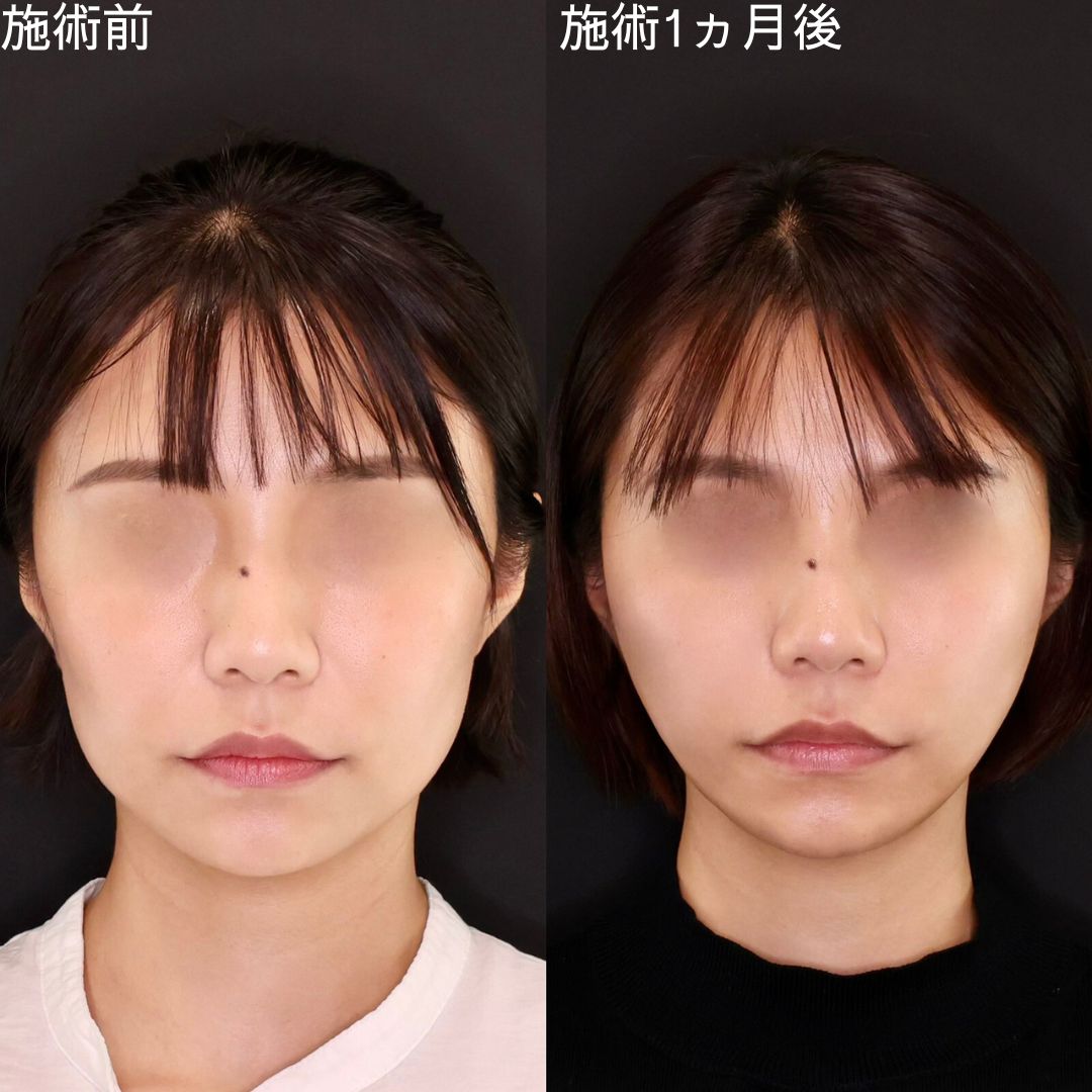 【糸リフト×脂肪除去】確実な変化を出すDr.石橋の小顔術