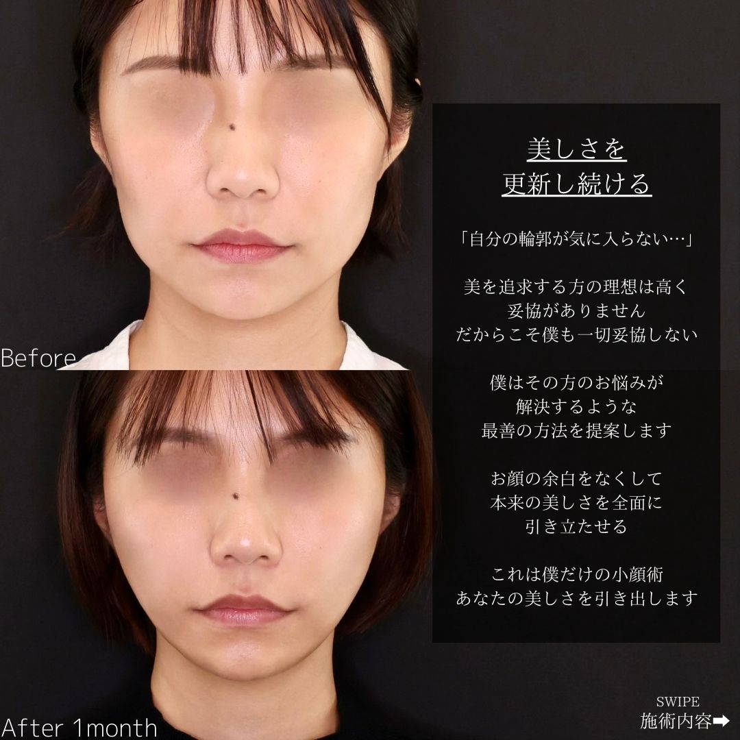 TAC式 ツヤ肌コラーゲンリフト®の症例写真 施術前後 