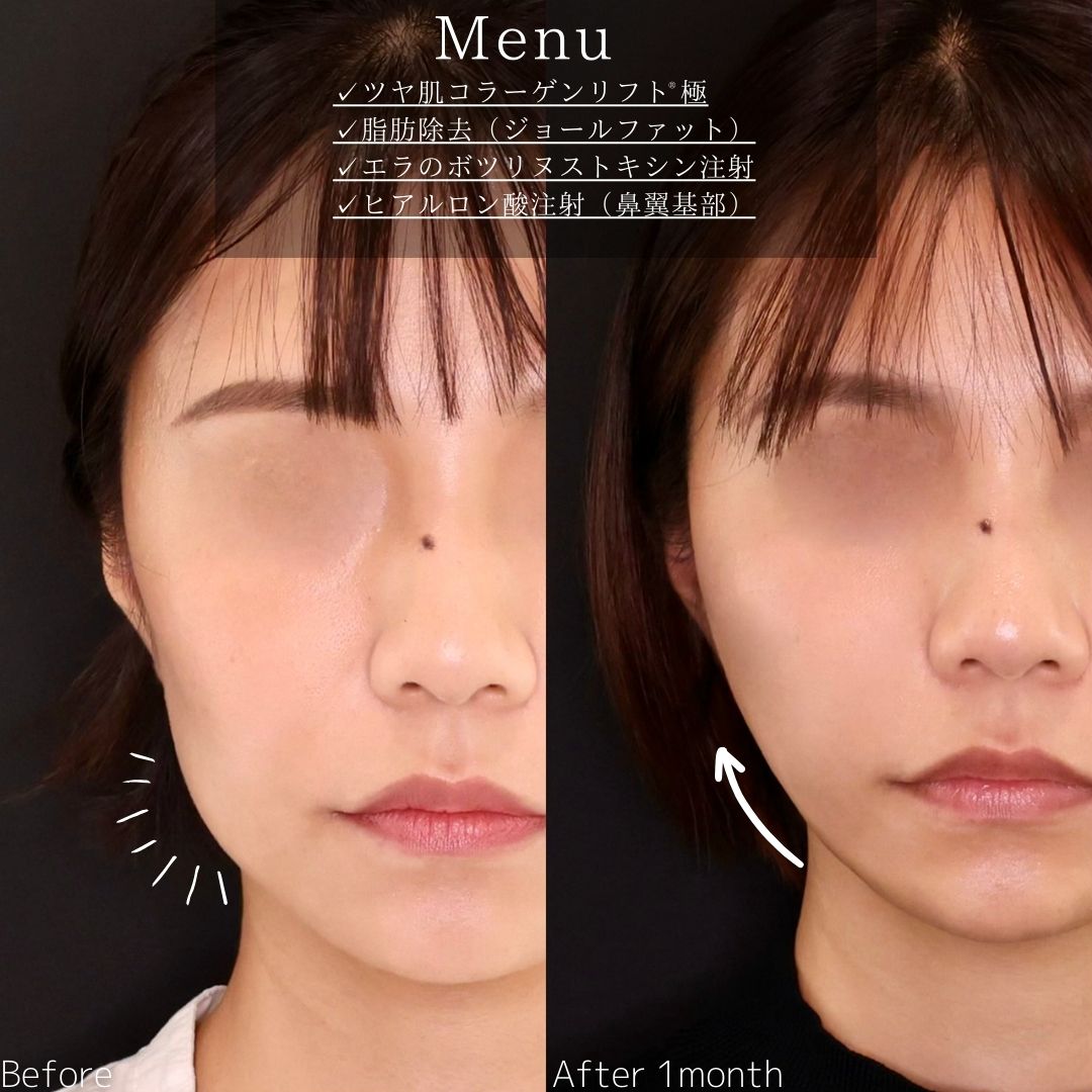 TAC式 ツヤ肌コラーゲンリフト®の症例写真 施術前後 