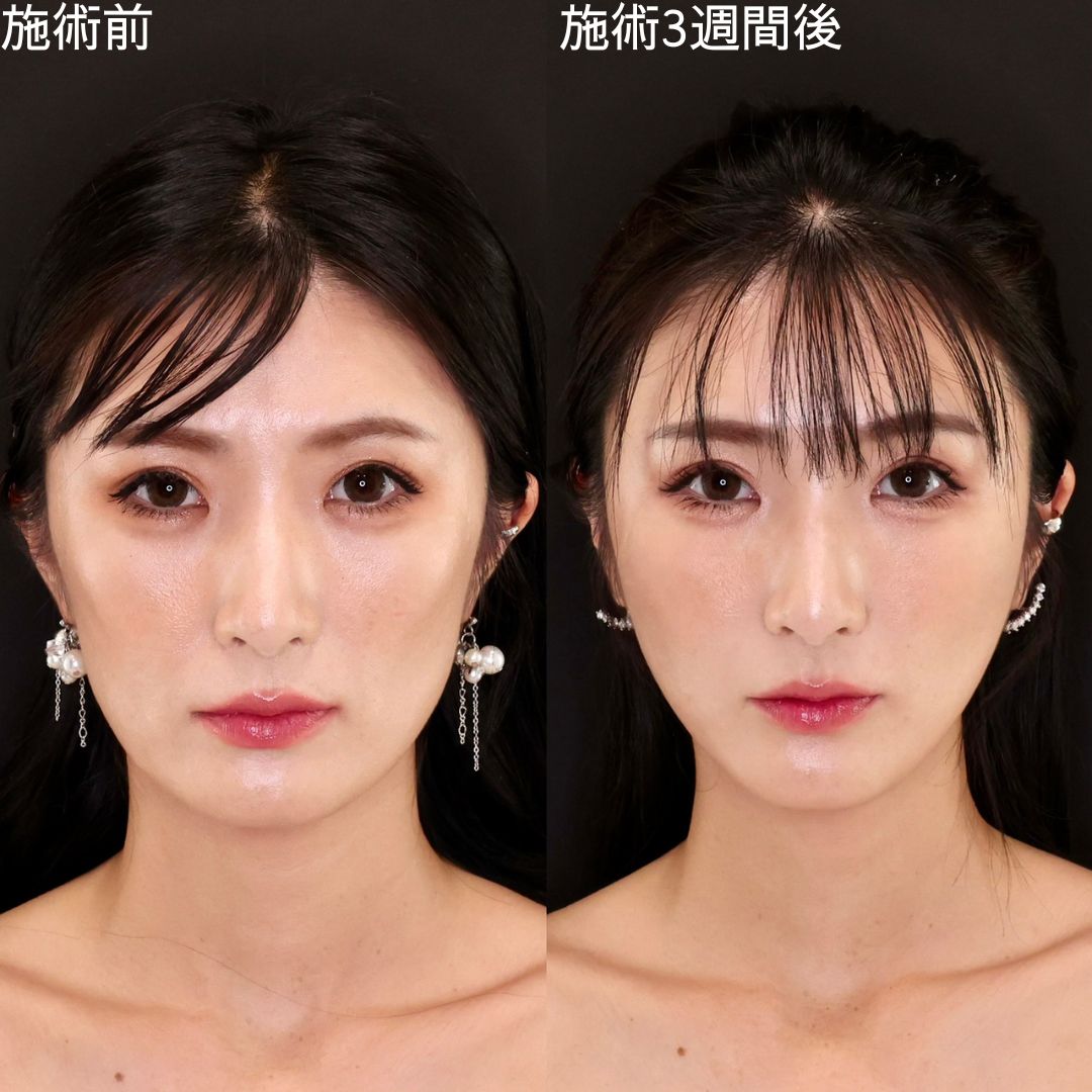 【糸リフト】ナチュラルな変化で洗練 Dr.石橋の小顔術