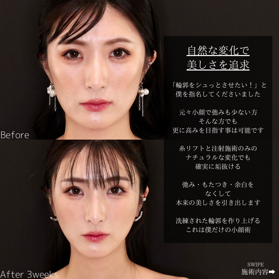 TAC式 ツヤ肌コラーゲンリフト®/エラボトックス注射の症例写真 施術前後 