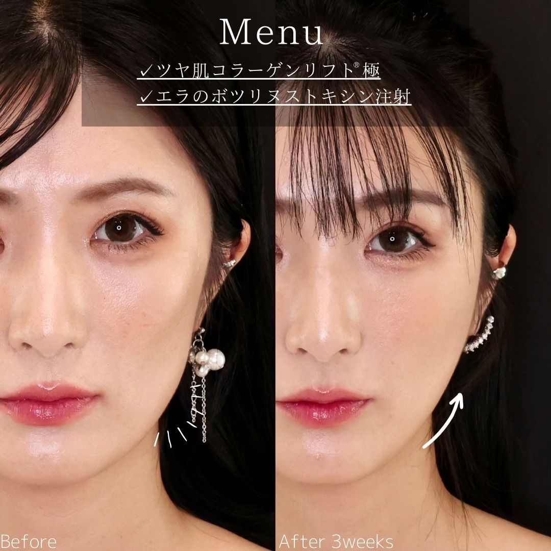 TAC式 ツヤ肌コラーゲンリフト®/エラボトックス注射の症例写真 施術前後 