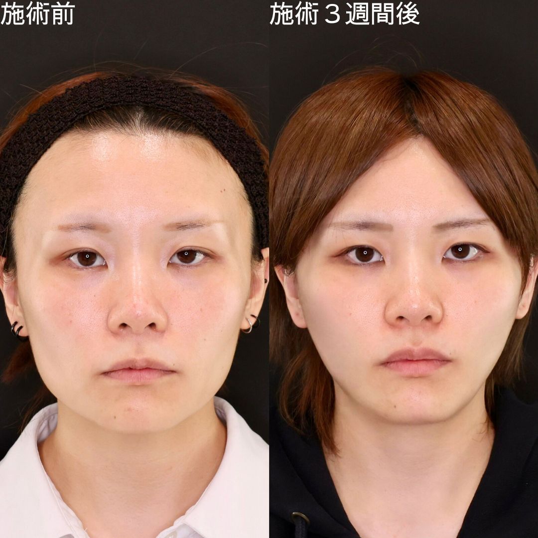 TAC式 ツヤ肌コラーゲンリフト®/エラボトックス注射の症例写真 施術前後 