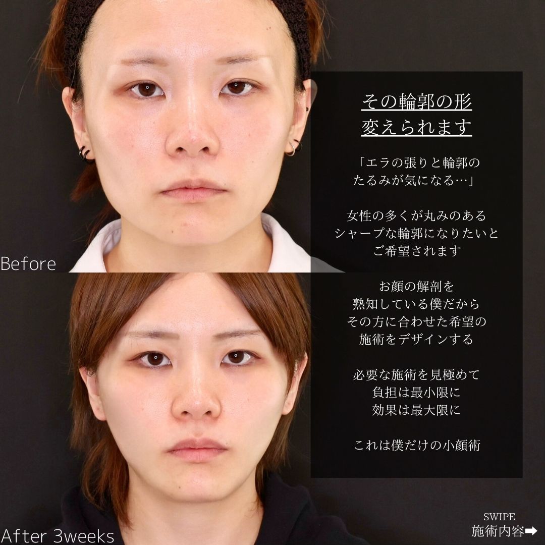 TAC式 ツヤ肌コラーゲンリフト®/エラボトックス注射の症例写真 施術前後 