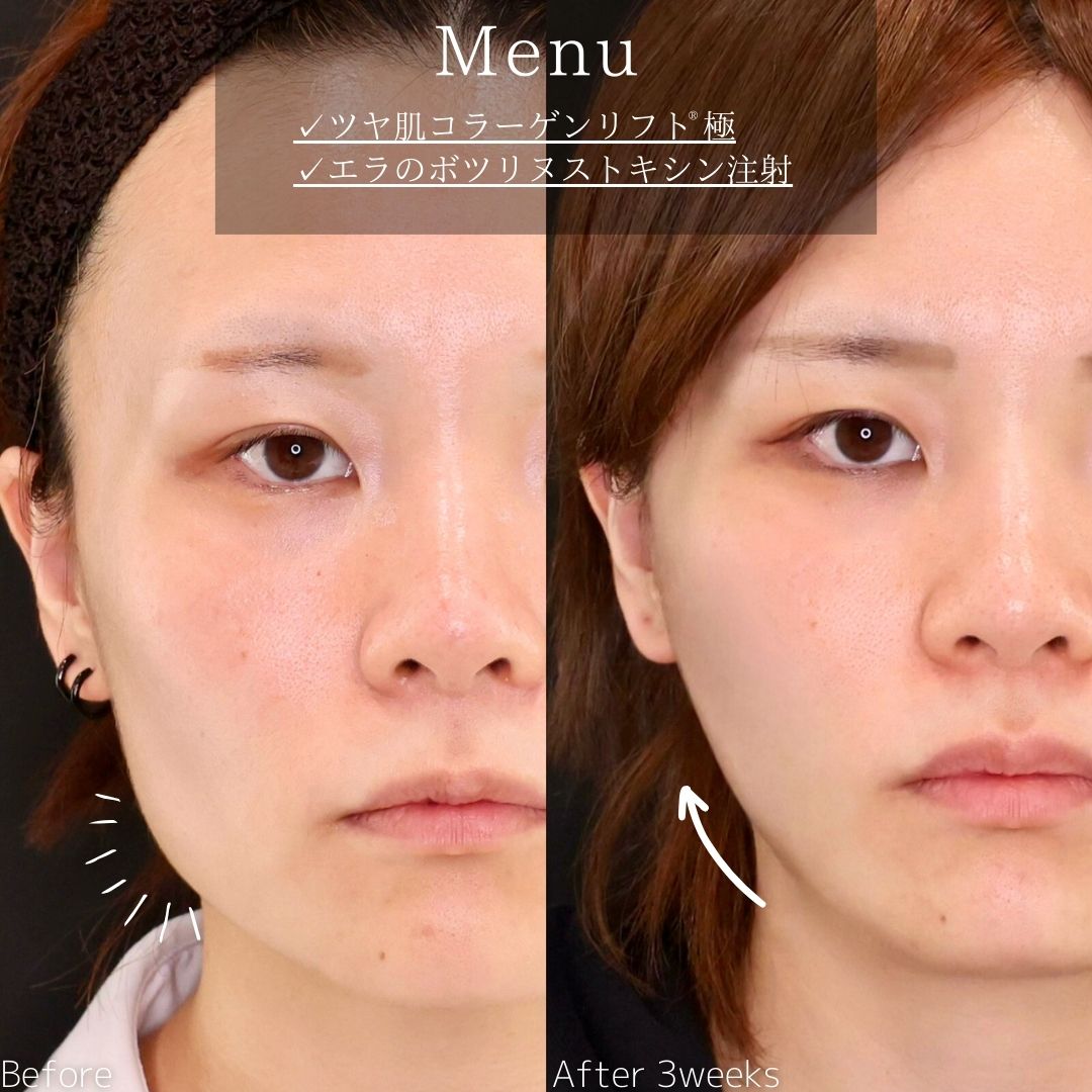 TAC式 ツヤ肌コラーゲンリフト®/エラボトックス注射の症例写真 施術前後 