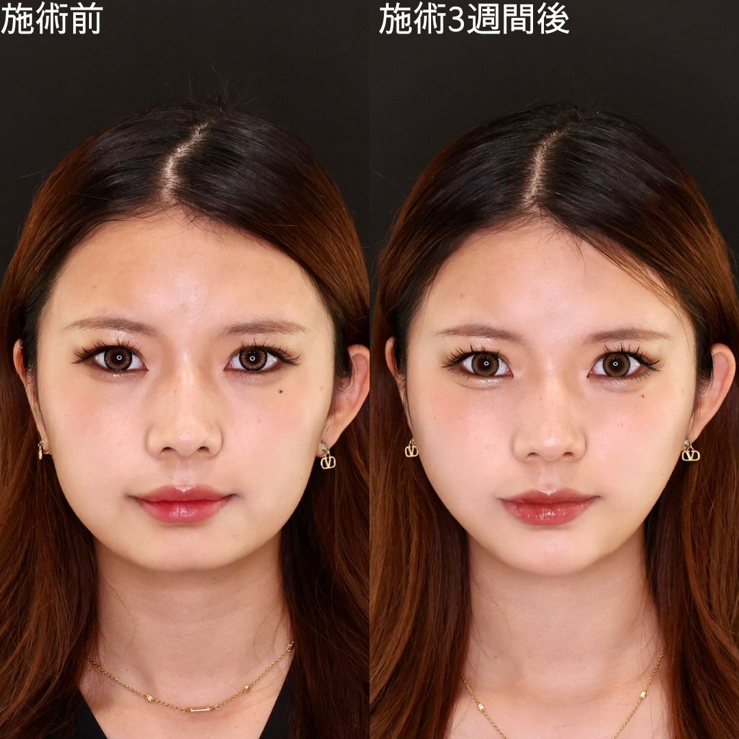 【糸リフト】輪郭を洗練させ美を極める Dr.石橋の小顔術