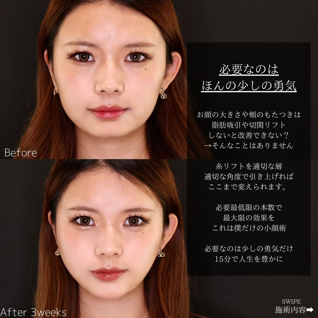 TAC式 ツヤ肌コラーゲンリフト®/顎のヒアルロン酸注射の症例写真 施術前後 