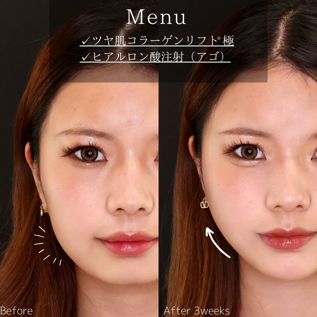 TAC式 ツヤ肌コラーゲンリフト®/顎のヒアルロン酸注射の症例写真 施術前後 