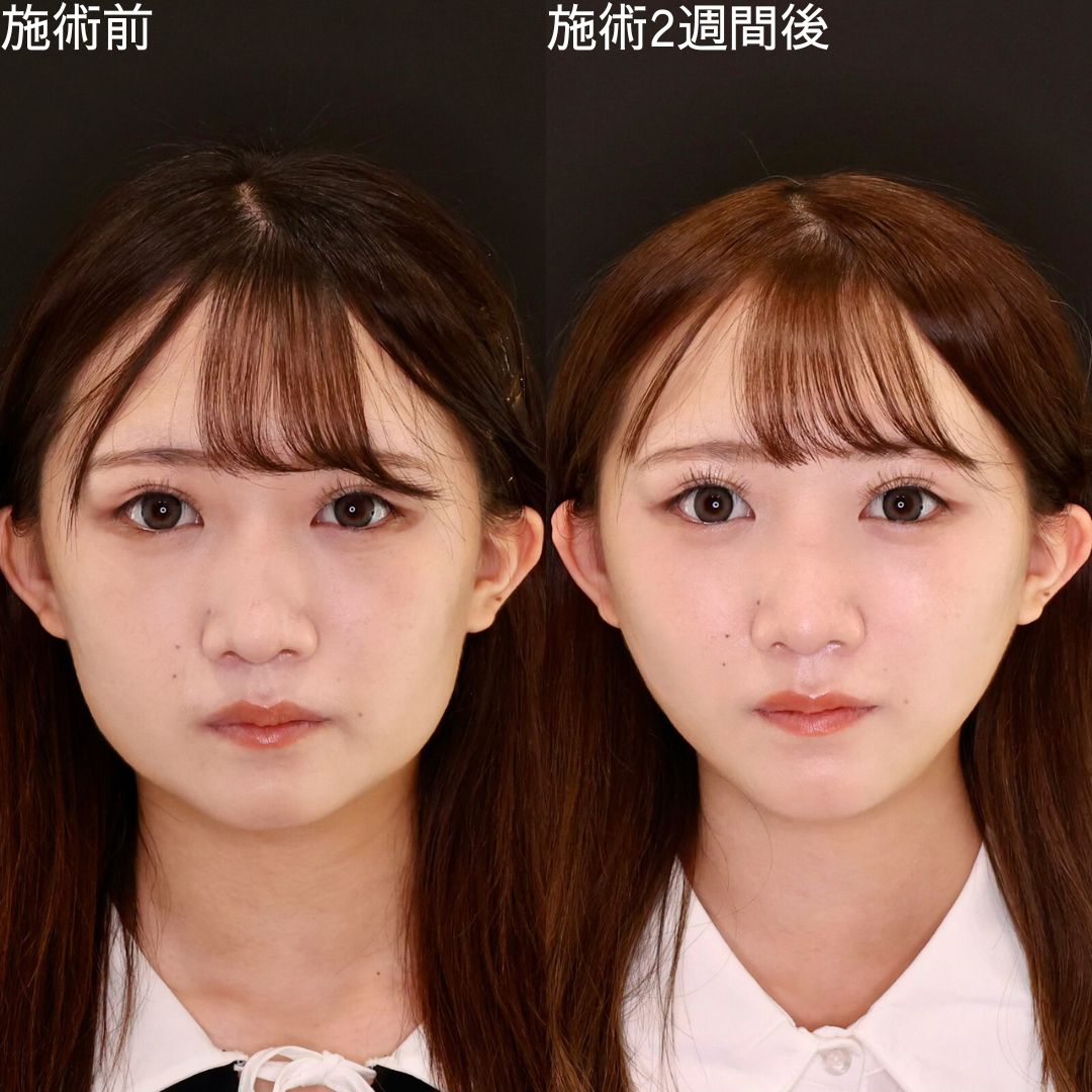 【糸リフト×脂肪吸引】Dr.石橋のアイドル級小顔術