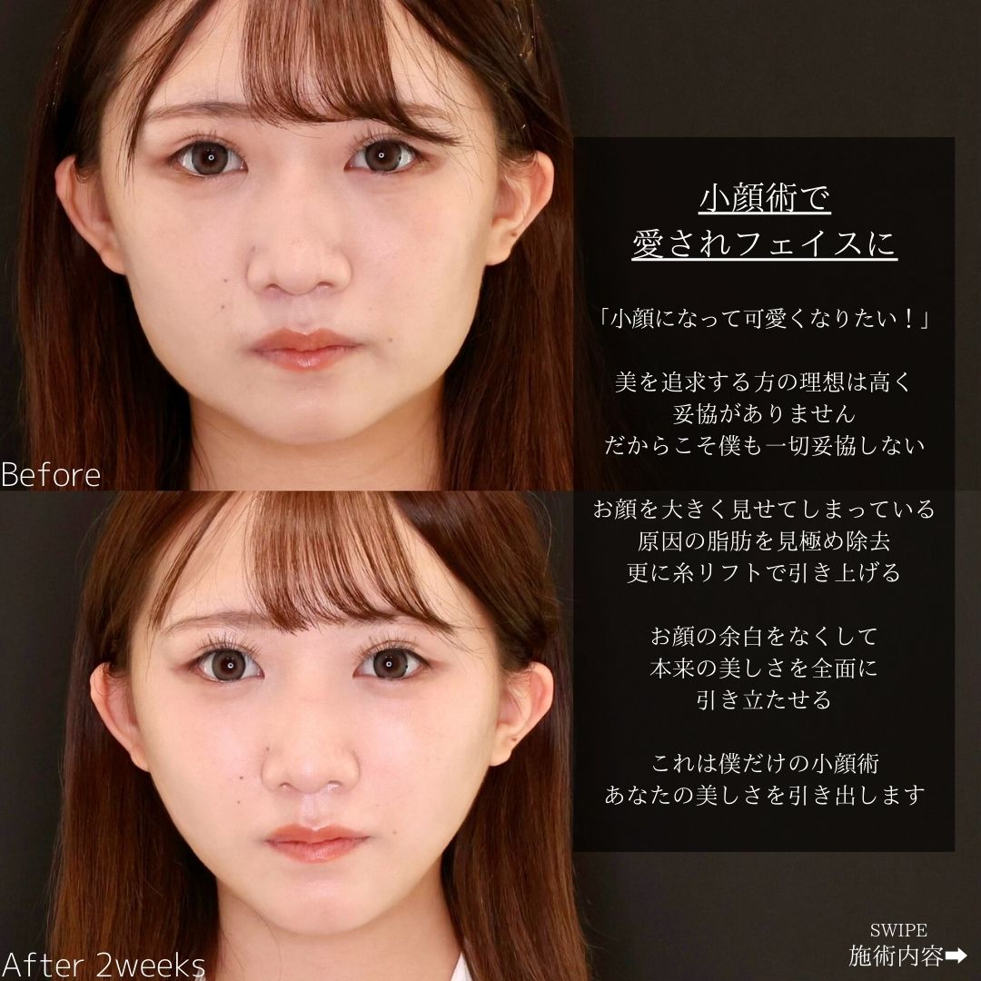 TAC式 ツヤ肌コラーゲンリフト®/顔の脂肪吸引/エラボトックス注射の症例写真 施術前後 