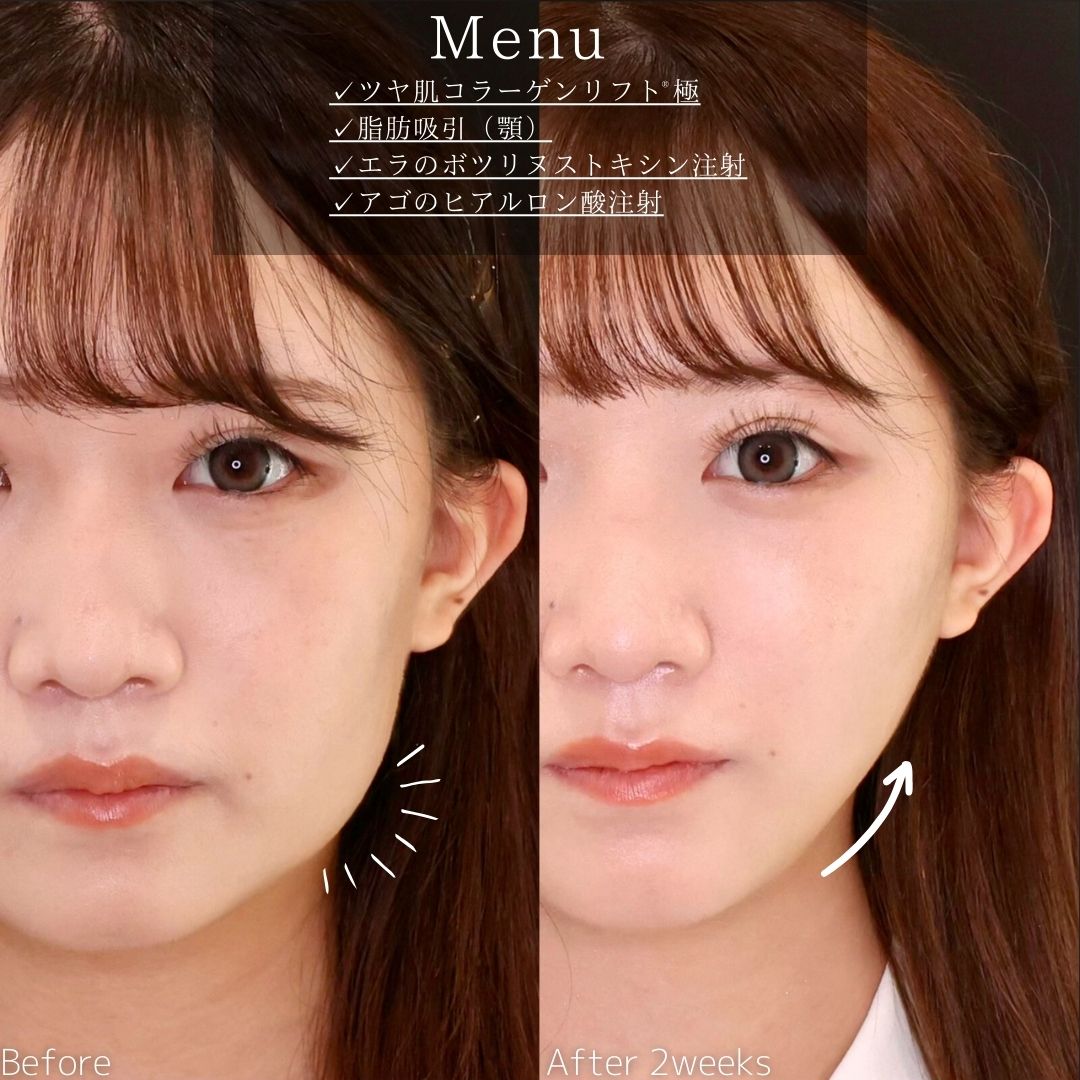 TAC式 ツヤ肌コラーゲンリフト®/顔の脂肪吸引/エラボトックス注射の症例写真 施術前後 
