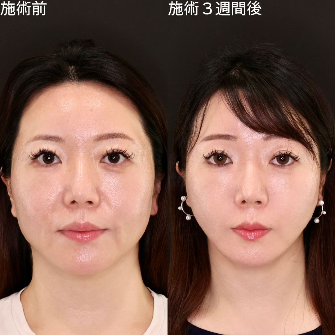 TAC式 ツヤ肌コラーゲンリフト®の症例写真 施術前後