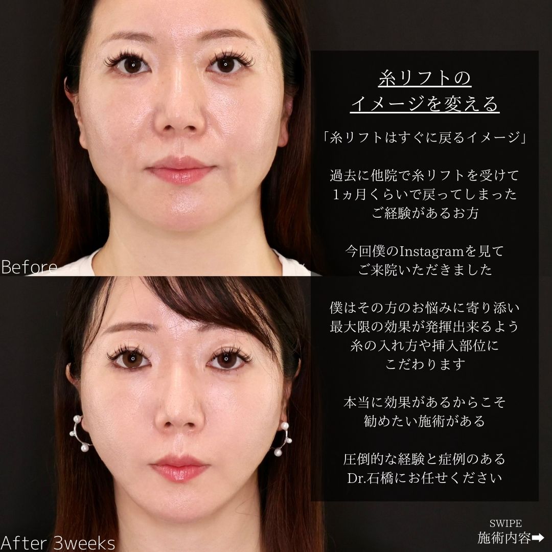 TAC式 ツヤ肌コラーゲンリフト®の症例写真 施術前後