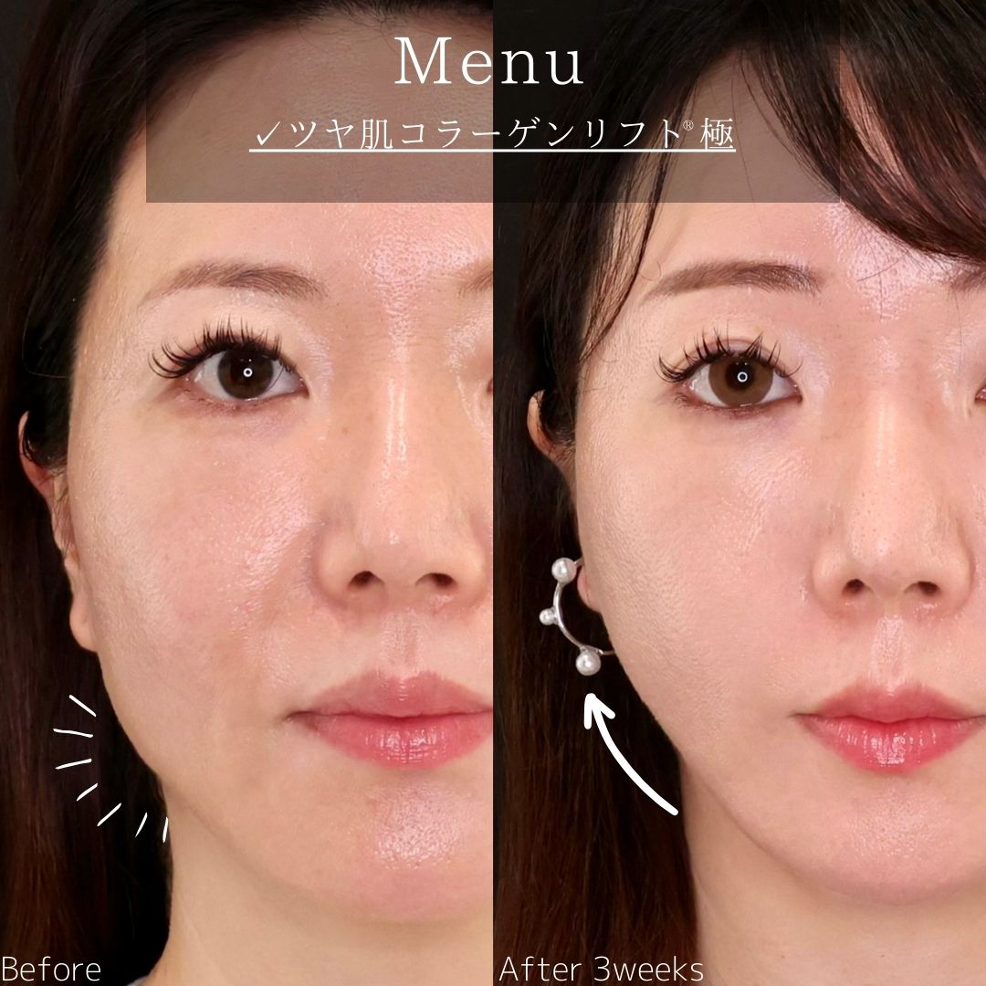 TAC式 ツヤ肌コラーゲンリフト®の症例写真 施術前後