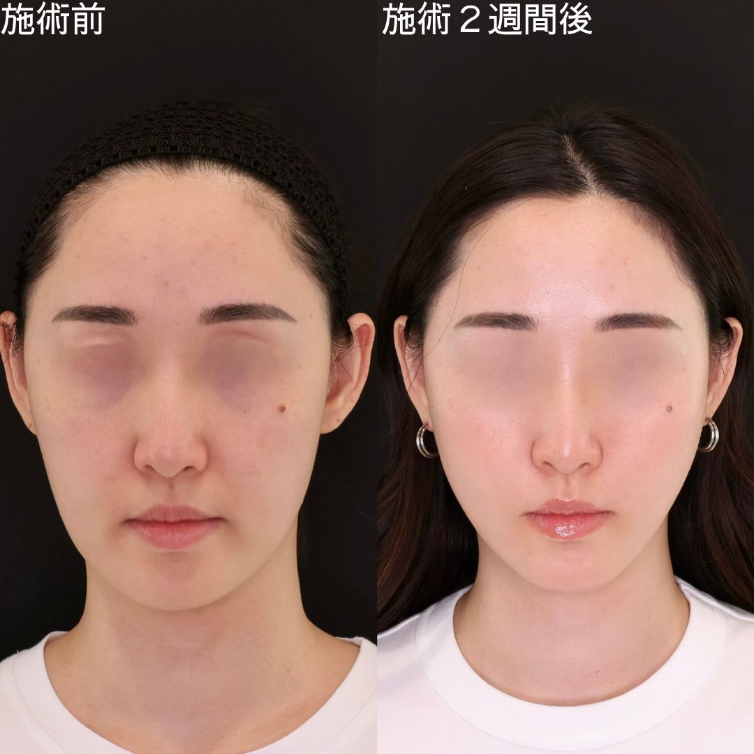 【糸リフト】Dr.石橋の小顔術で顔の左右差を改善して垢抜ける