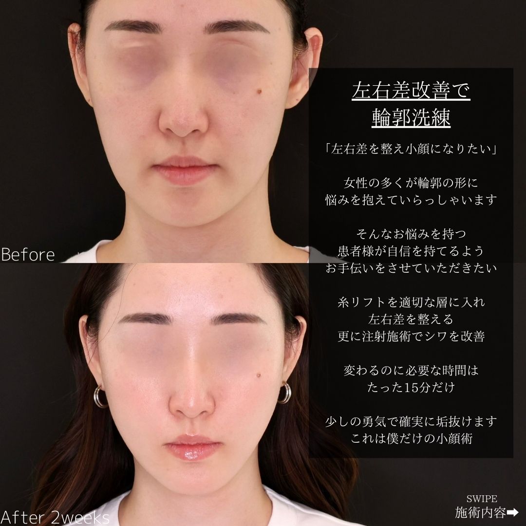 糸リフト】Dr.石橋の小顔術で顔の左右差を改善して垢抜ける｜症例写真 