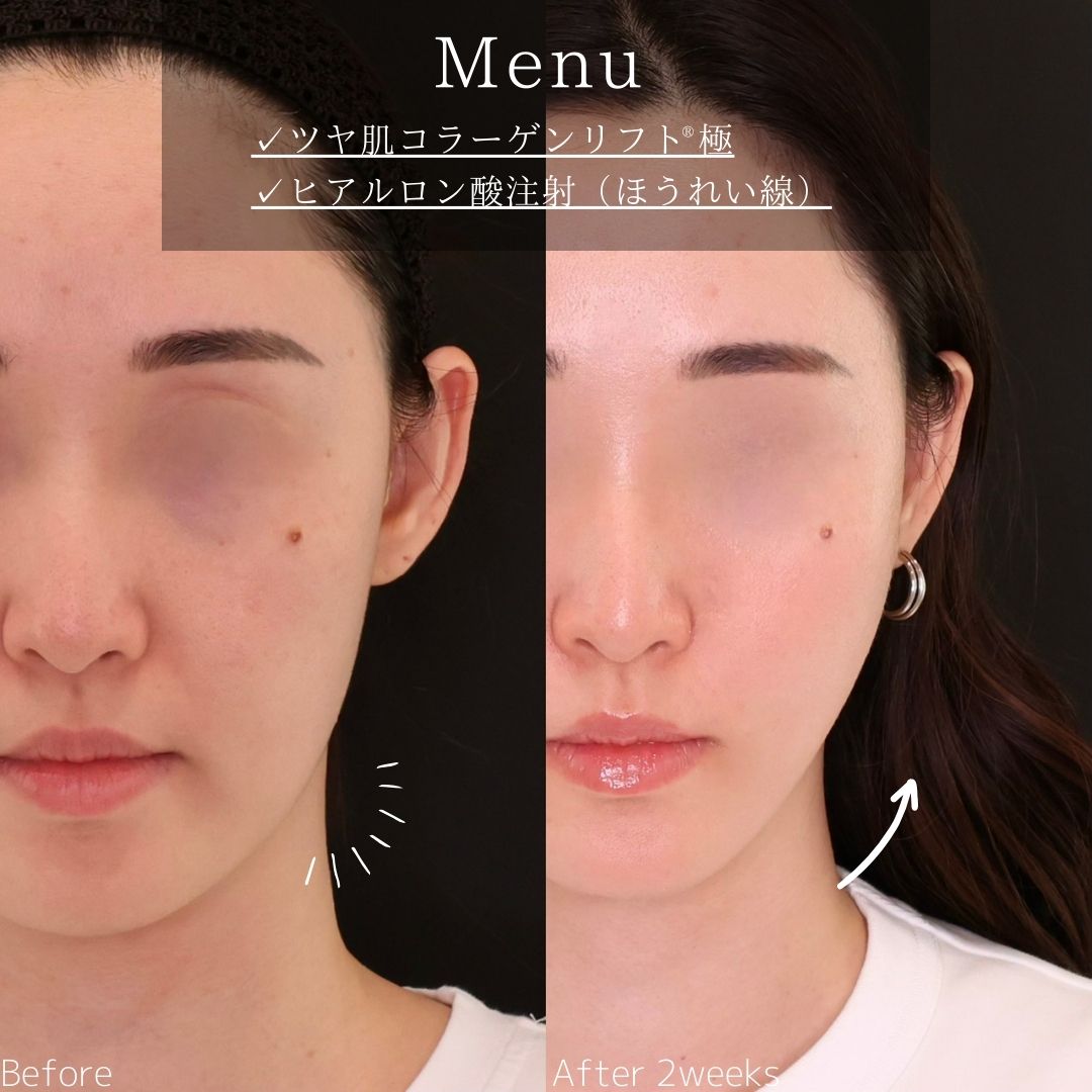 TAC式 ツヤ肌コラーゲンリフト®/ほうれい線のヒアルロン酸注射の症例写真 施術前後 