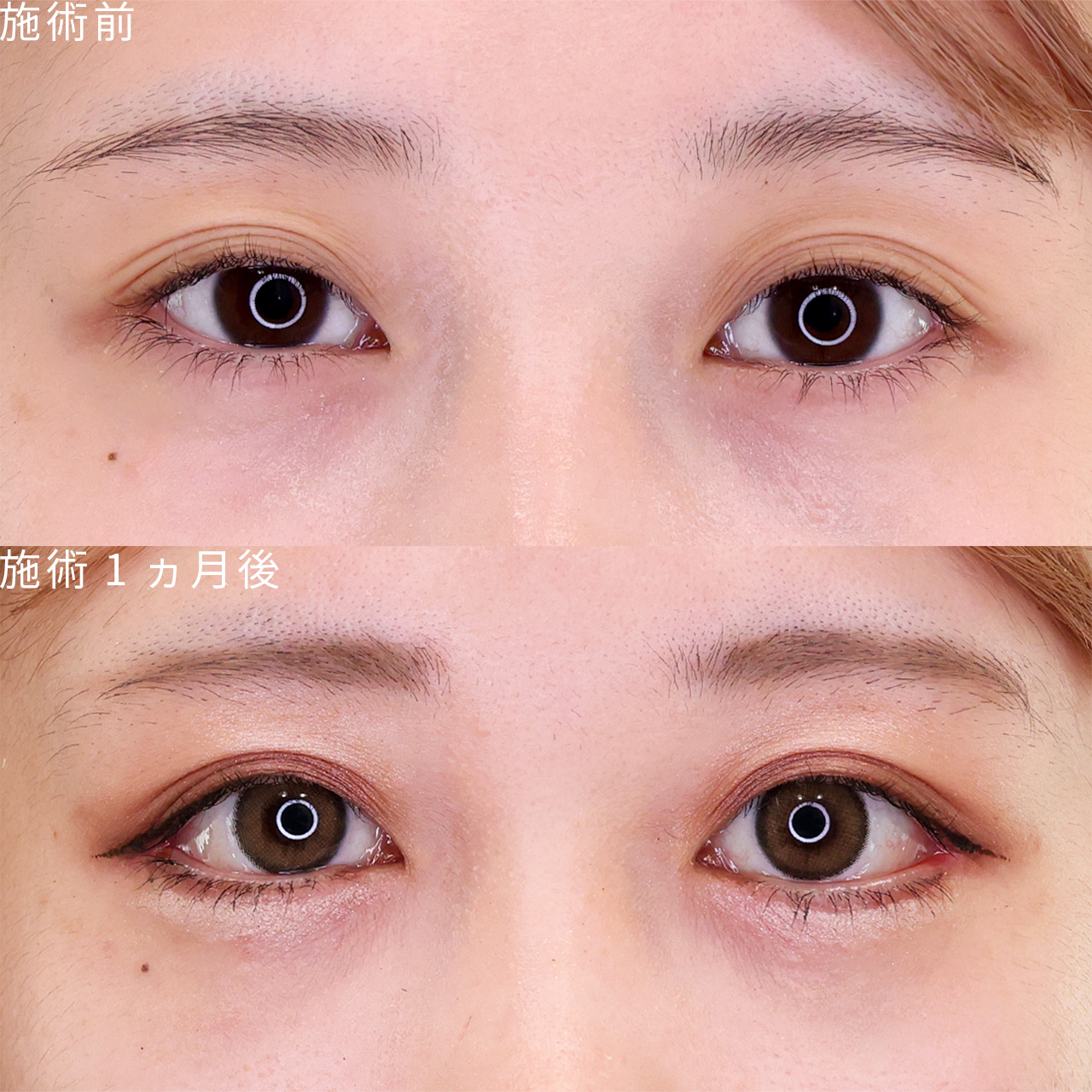 【タレ目形成＋目尻切開術】目の幅を広げて可愛いドール級アイに