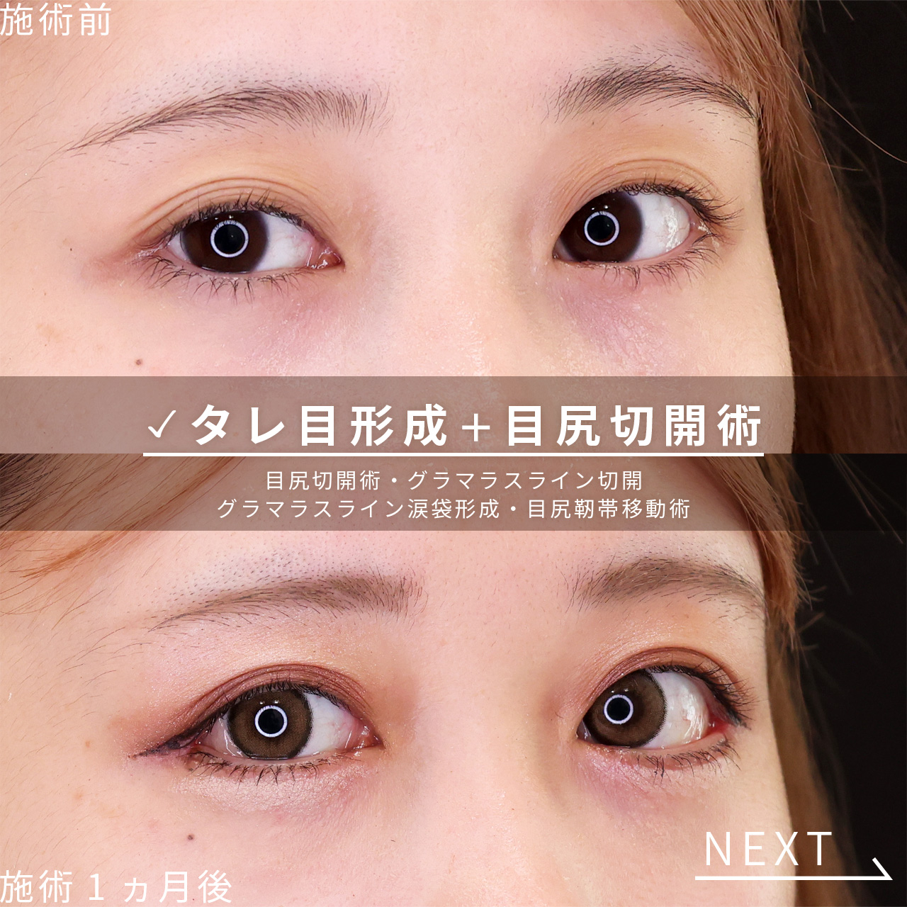 目尻切開術/グラマラスライン（タレ目形成）/目尻靭帯移動術の症例写真 施術前後 