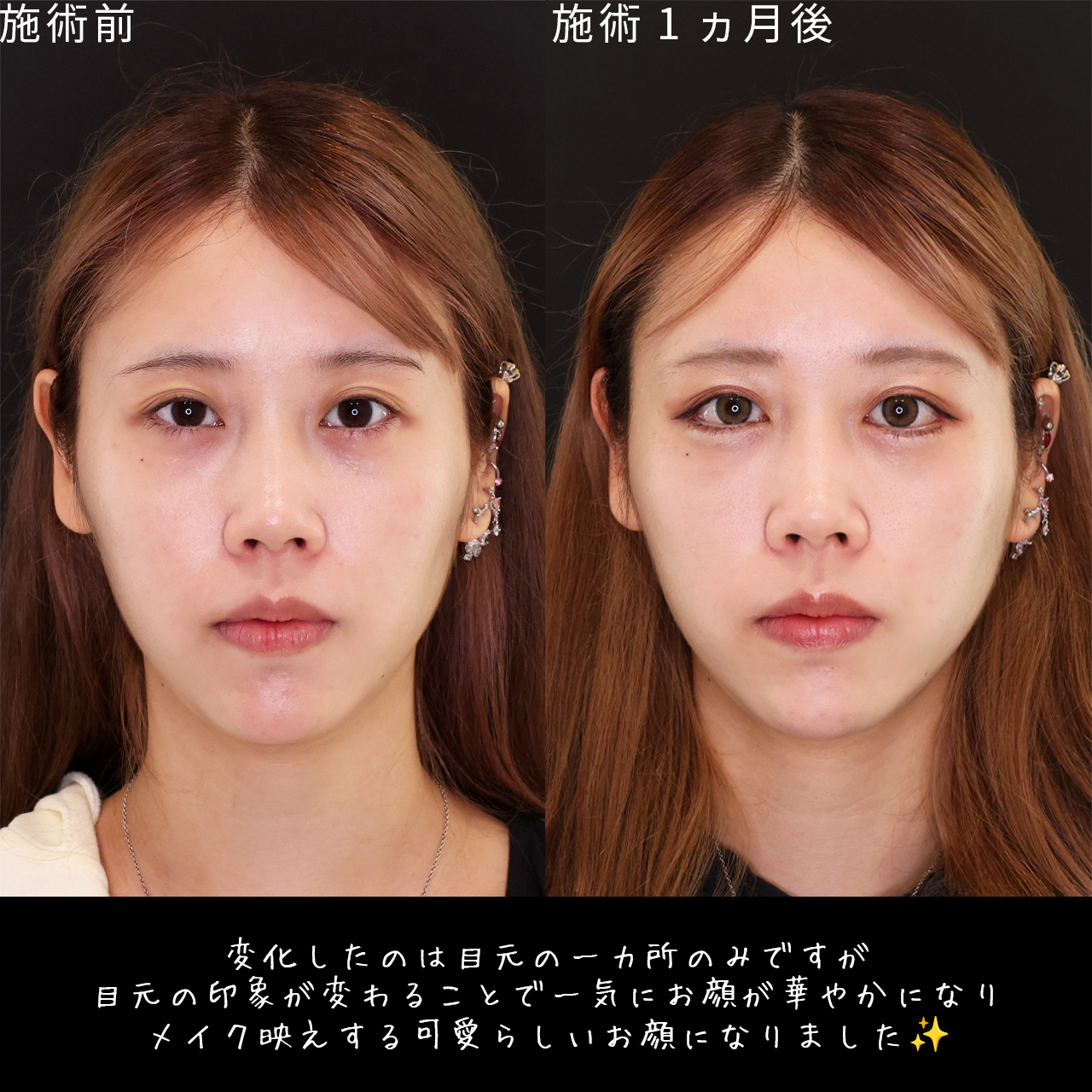 目尻切開術/グラマラスライン（タレ目形成）/目尻靭帯移動術の症例写真 施術前後 