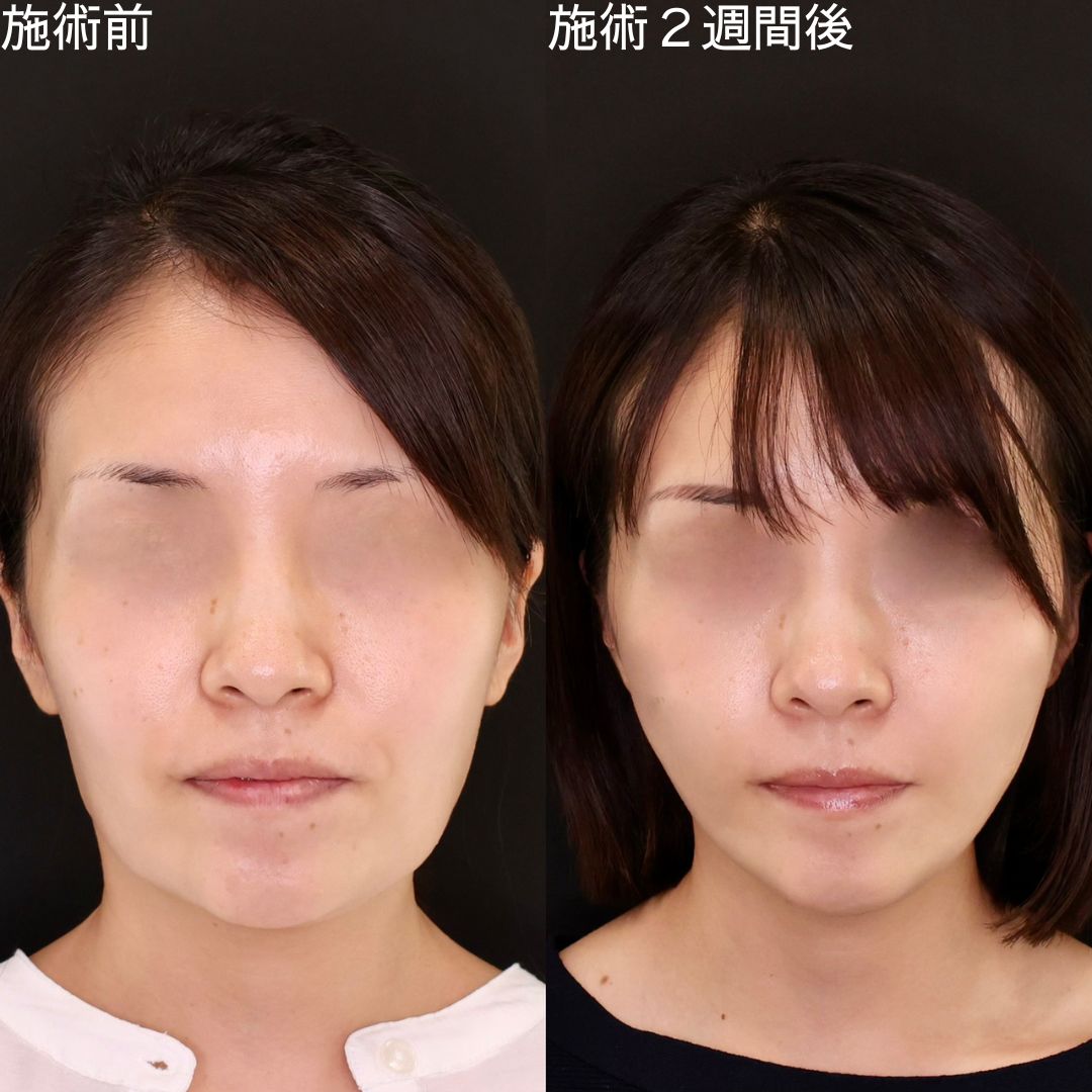 TAC式 ツヤ肌コラーゲンリフト®/ほうれい線のヒアルロン酸注射の症例写真 施術前後