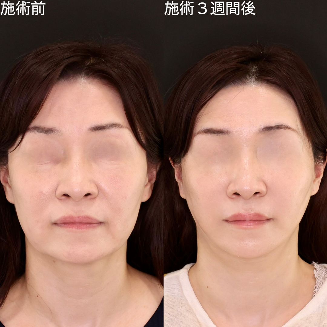 【糸リフト】Dr.石橋のナチュラル小顔整形