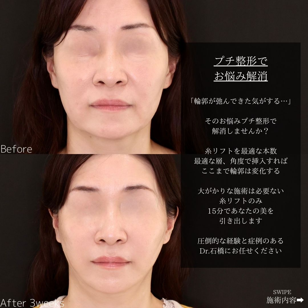 TAC式 ツヤ肌コラーゲンリフト®の症例写真 施術前後 