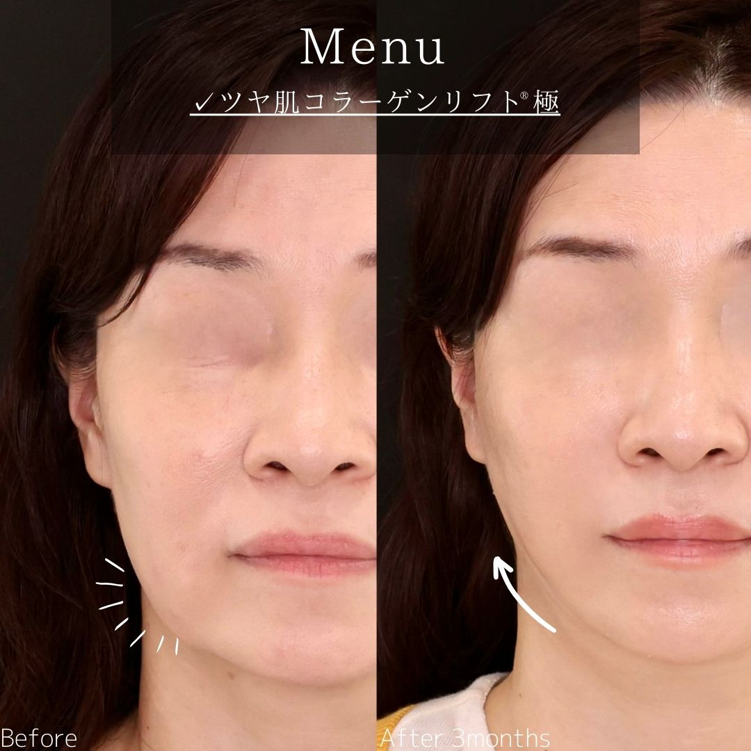 TAC式 ツヤ肌コラーゲンリフト®の症例写真 施術前後 