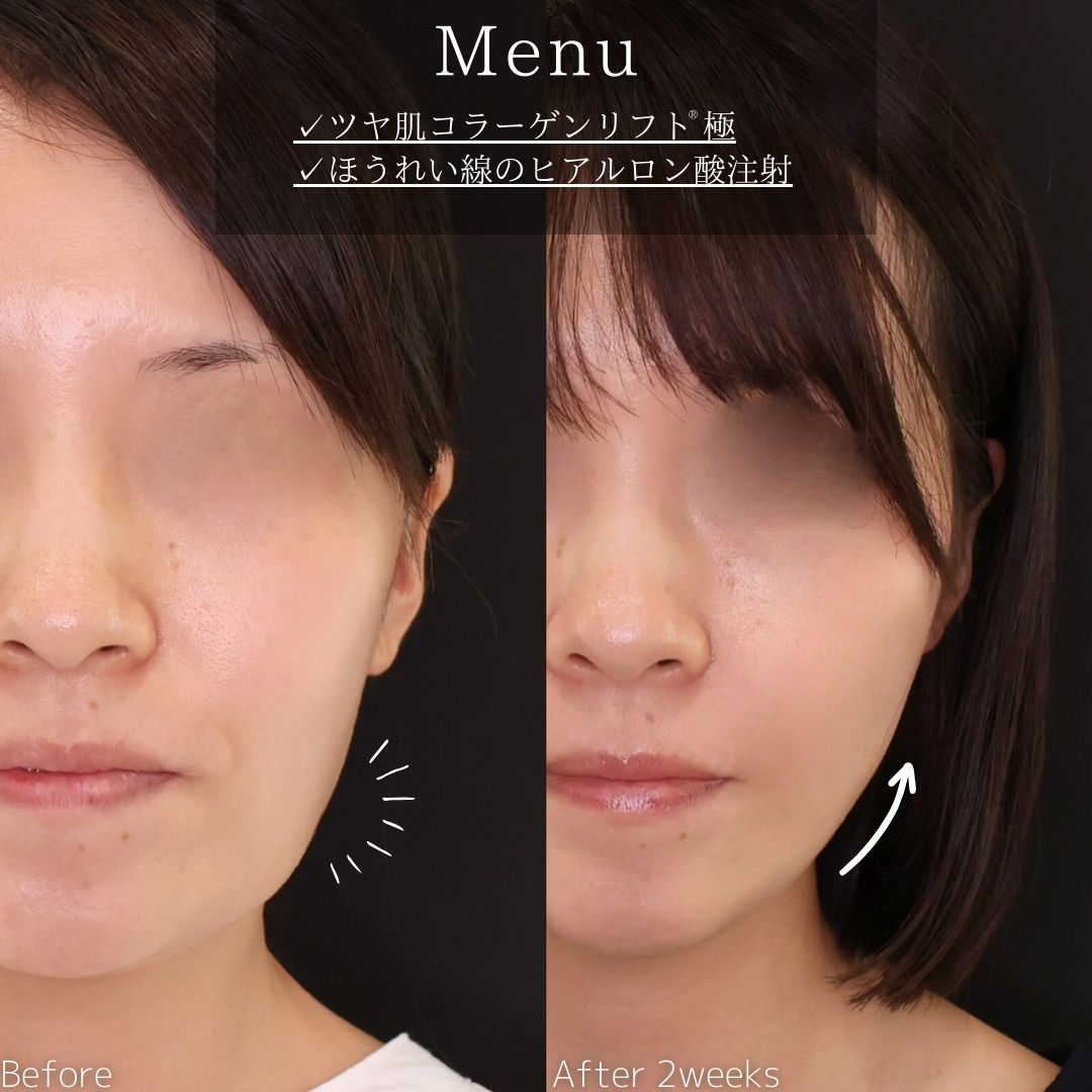 TAC式 ツヤ肌コラーゲンリフト®/ほうれい線のヒアルロン酸注射の症例写真 施術前後