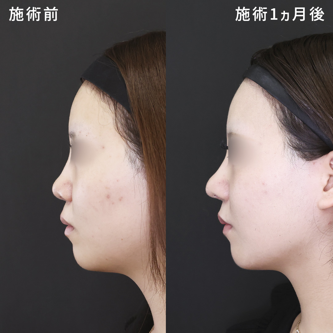 鼻中隔延長術/鼻尖形成・鼻尖縮小/鼻先軟骨移植の症例写真 施術前後