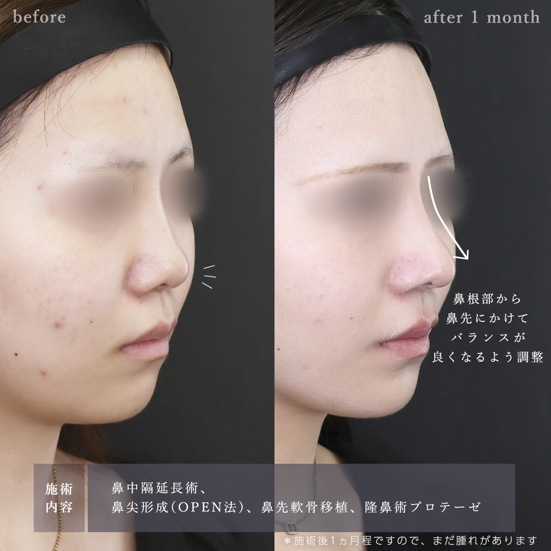 鼻中隔延長術/鼻尖形成・鼻尖縮小/鼻先軟骨移植の症例写真 施術前後