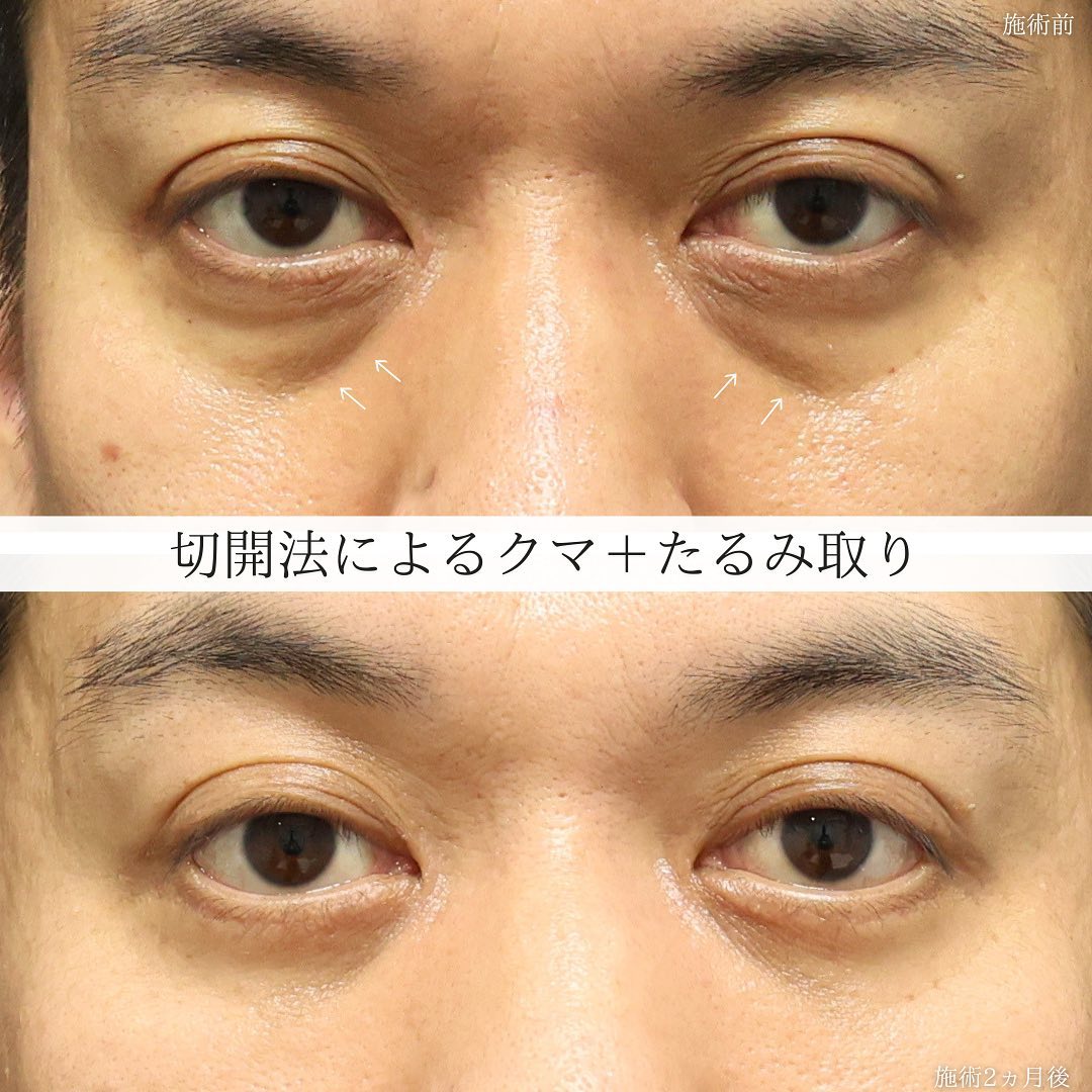 下眼瞼切開術（クマ・たるみとり）/下眼瞼脱脂術（目の下のたるみ取り・目の下の脂肪ふくらみ取り）/目の下のヒアルロン酸注射の症例写真 施術前後 