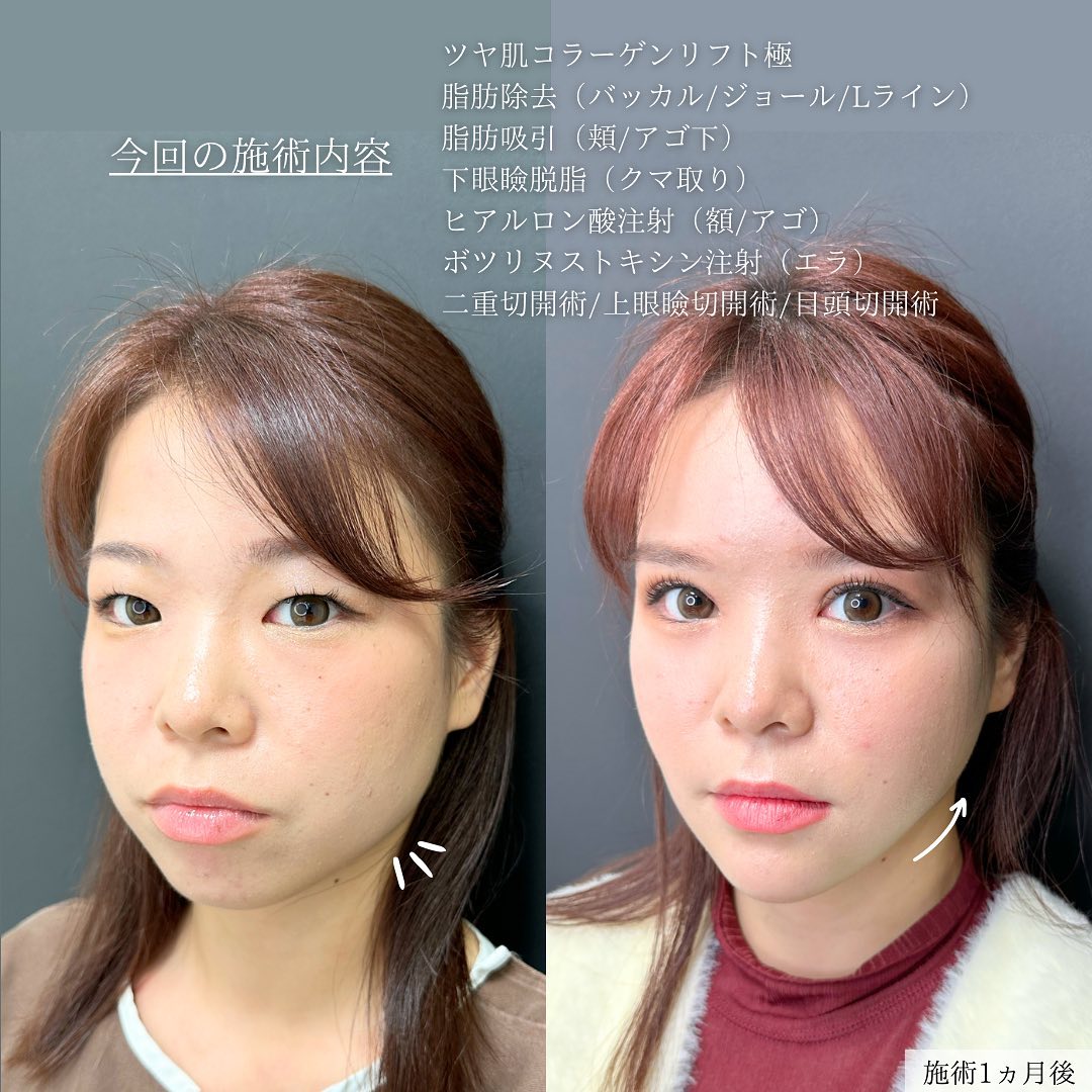 バッカルファット除去/ジョールファット除去/小顔整形｜パーフェクトフェイスラインの症例写真 施術前後 