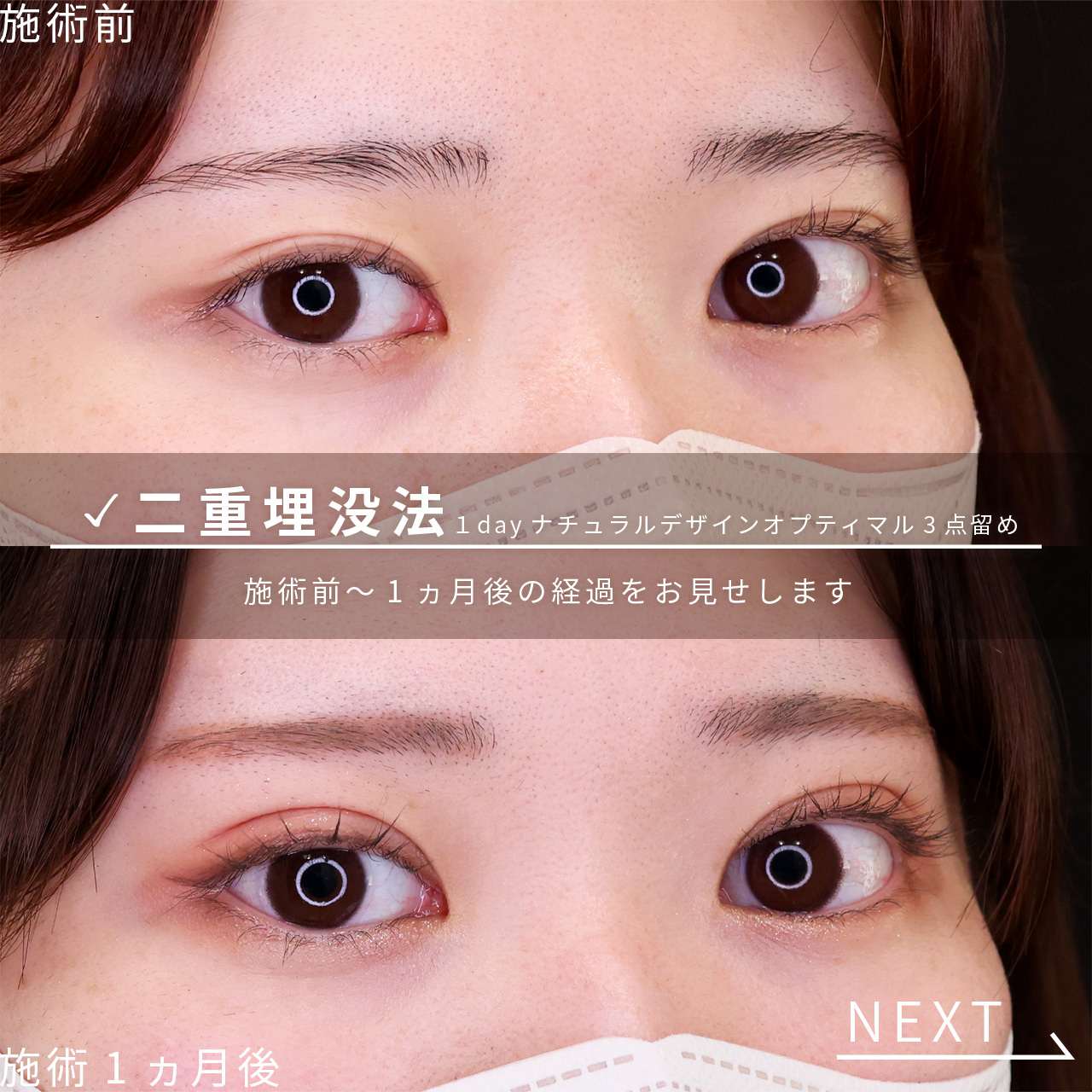 二重埋没法の症例写真 施術前後 