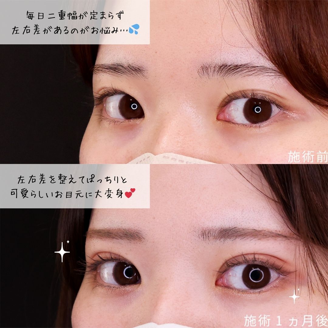 二重埋没法の症例写真 施術前後 