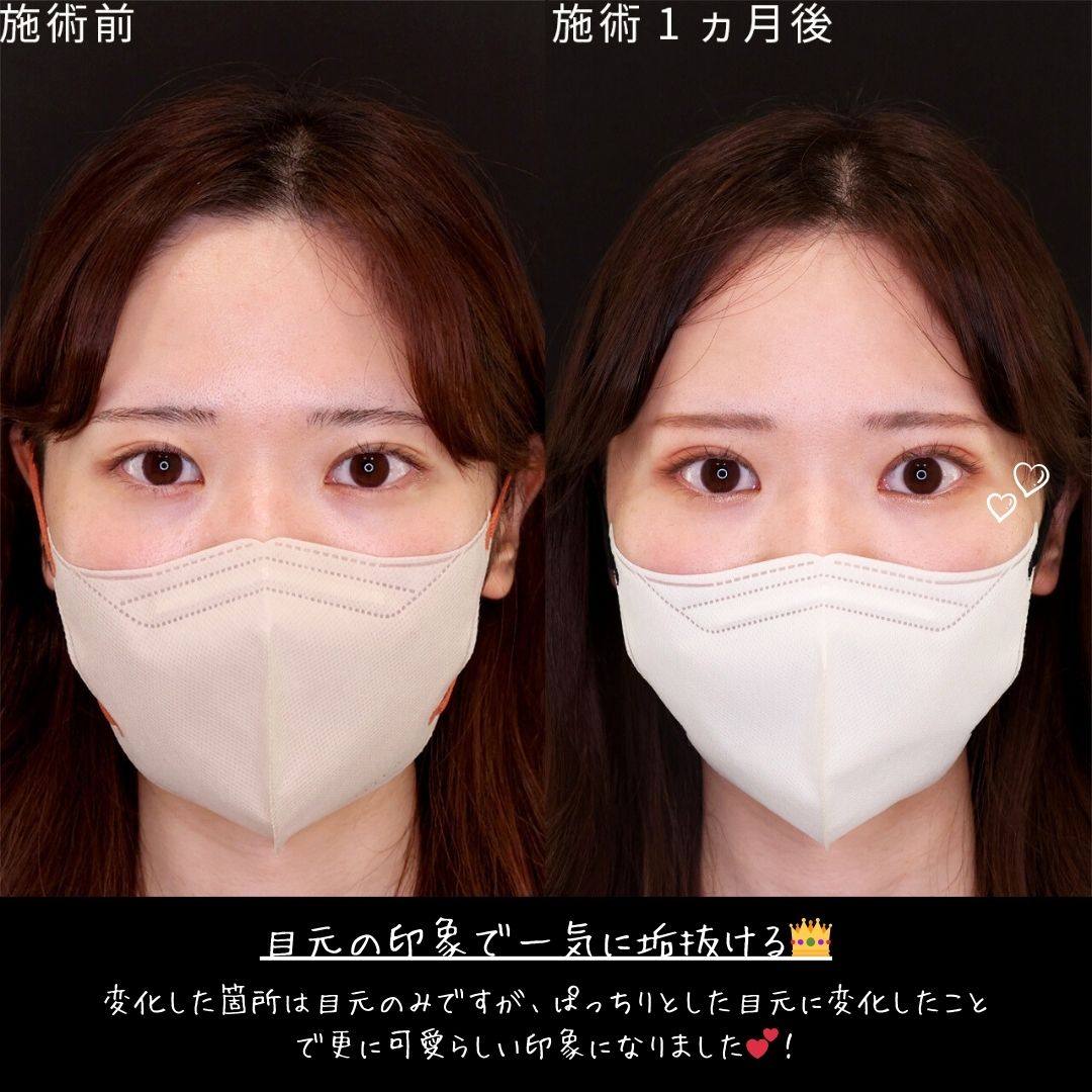 二重埋没法の症例写真 施術前後 