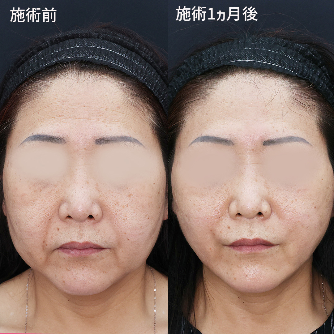 お顔のもたつきが改善され引き上がった輪郭に。