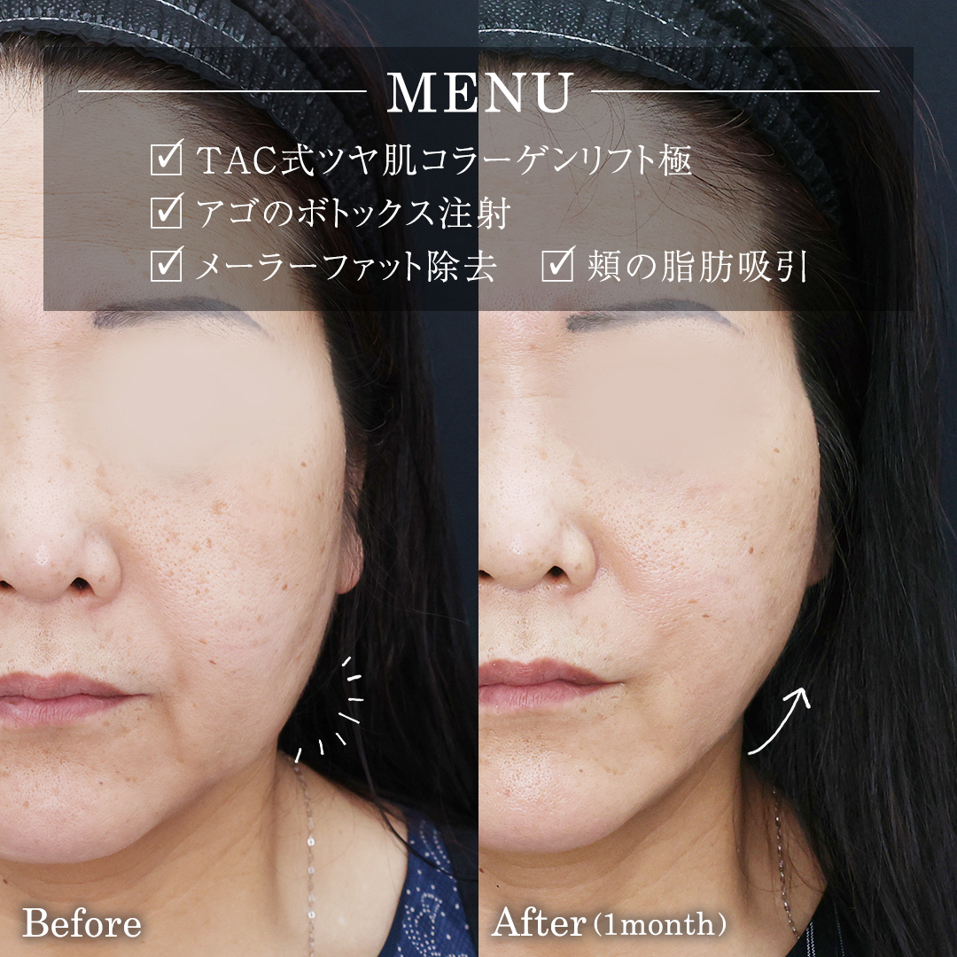 TAC式 ツヤ肌コラーゲンリフト®/ボトックス注射：その他/メーラーファット除去の症例写真 施術前後 
