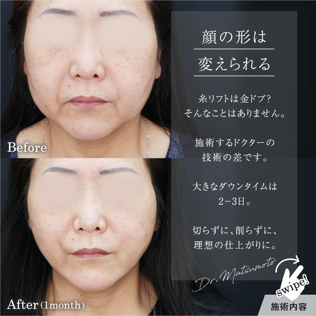 TAC式 ツヤ肌コラーゲンリフト®/ボトックス注射：その他/メーラーファット除去の症例写真 施術前後 