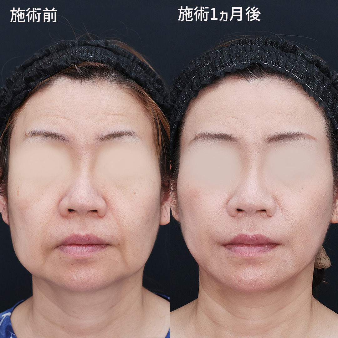 TAC式 ツヤ肌コラーゲンリフト®の症例写真 施術前後 