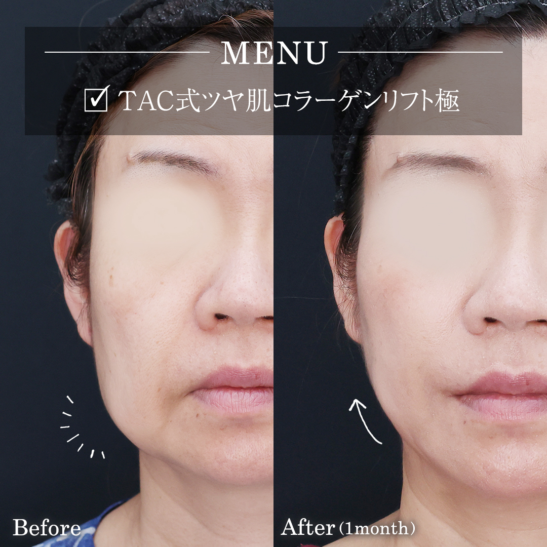 TAC式 ツヤ肌コラーゲンリフト®の症例写真 施術前後 