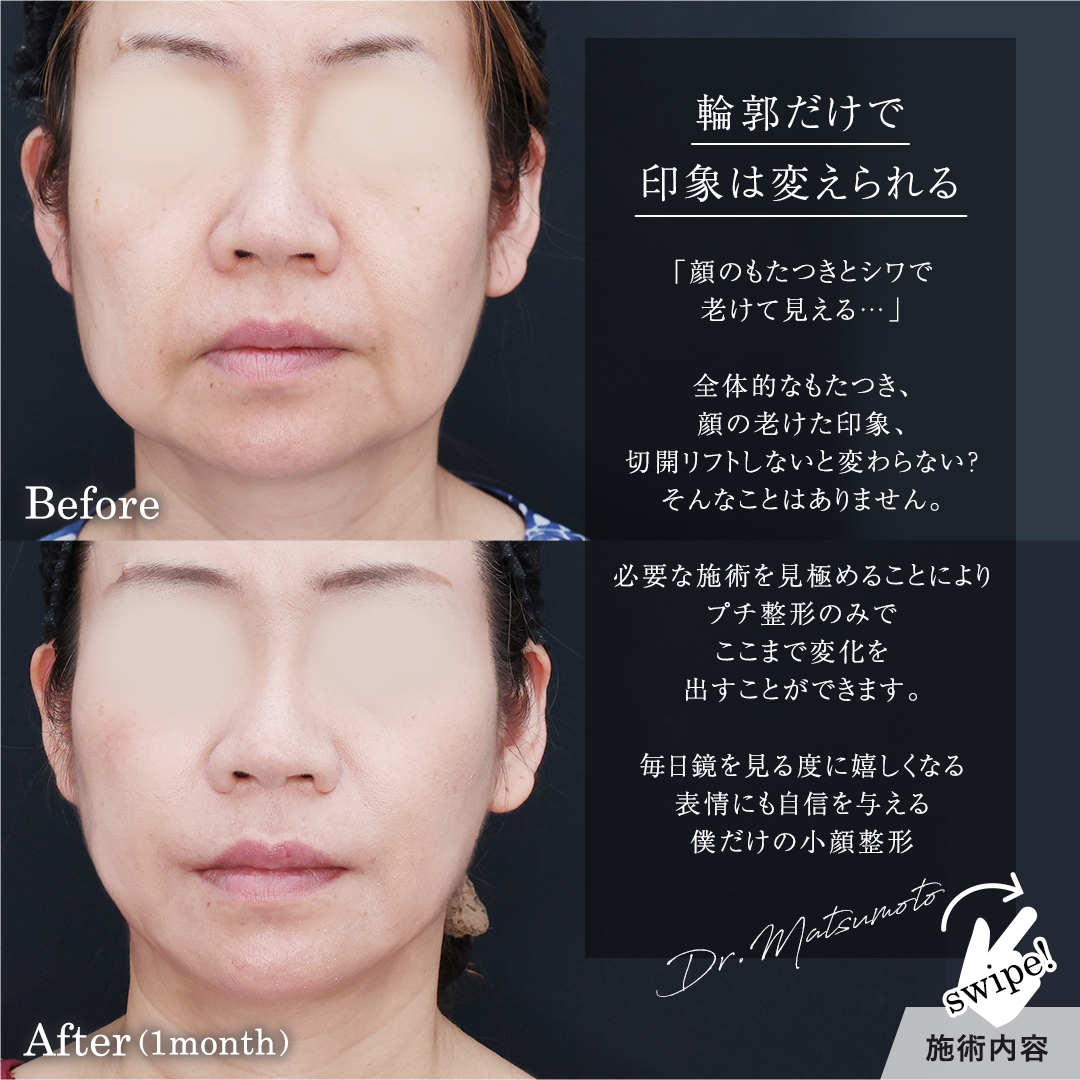 TAC式 ツヤ肌コラーゲンリフト®の症例写真 施術前後 