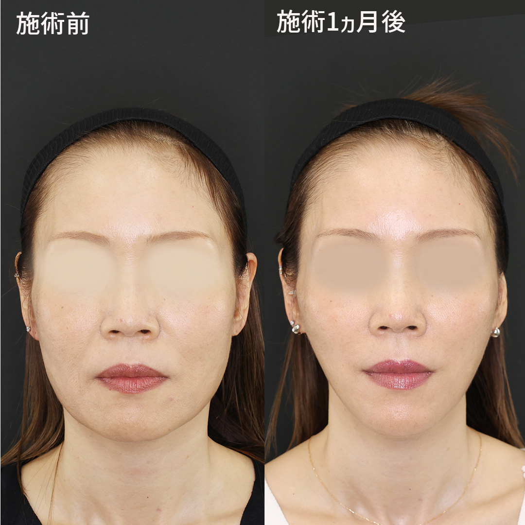 切らずに小顔が実現！？ 輪郭だけで印象が変わる！