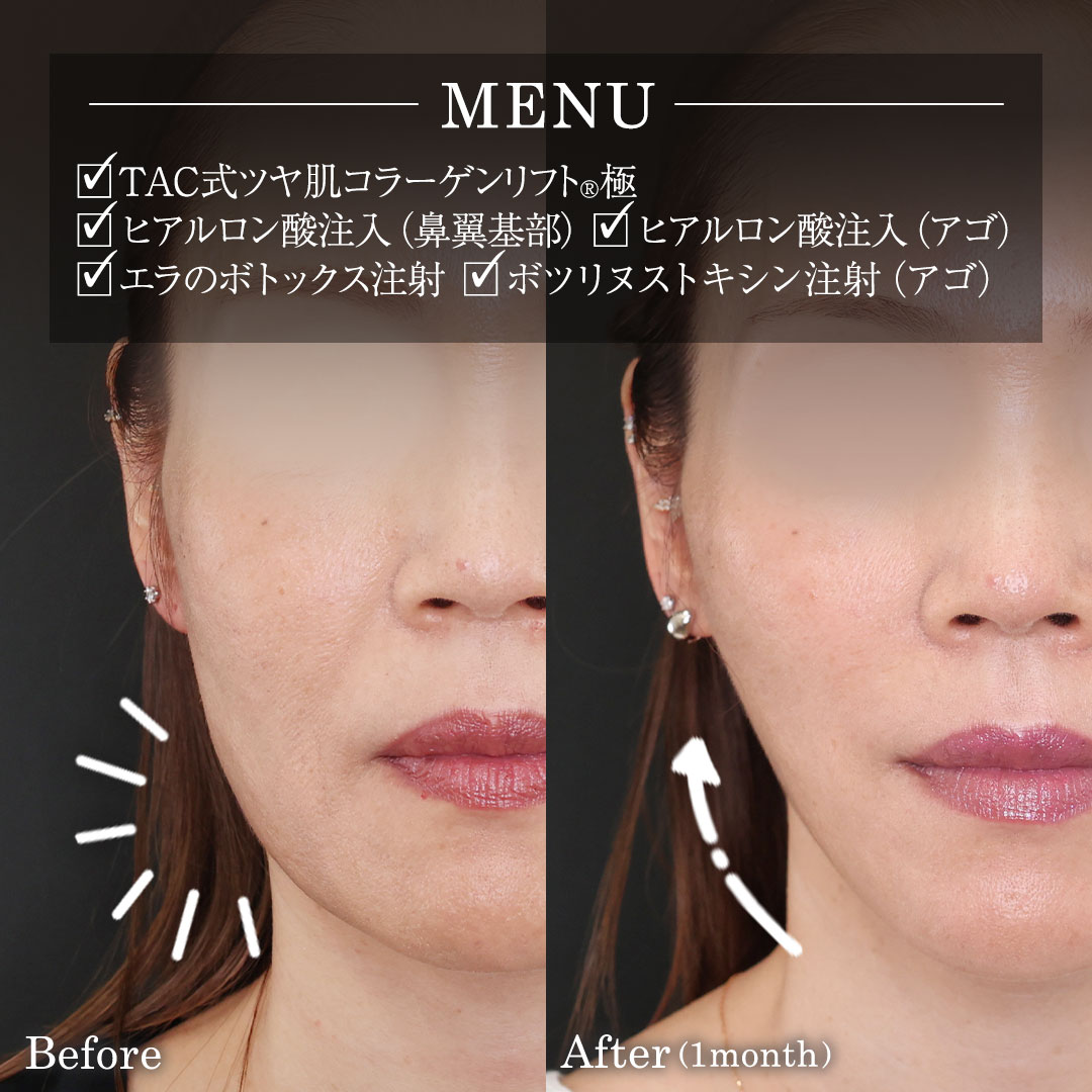 エラボトックス注射/TAC式 ツヤ肌コラーゲンリフト®/顎のヒアルロン酸注射の症例写真 施術前後 
