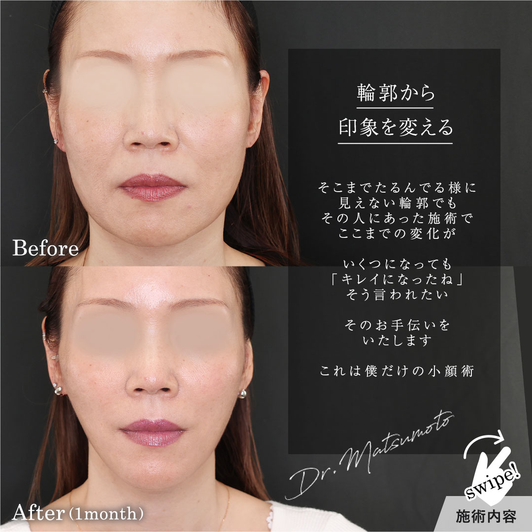 エラボトックス注射/TAC式 ツヤ肌コラーゲンリフト®/顎のヒアルロン酸注射の症例写真 施術前後 