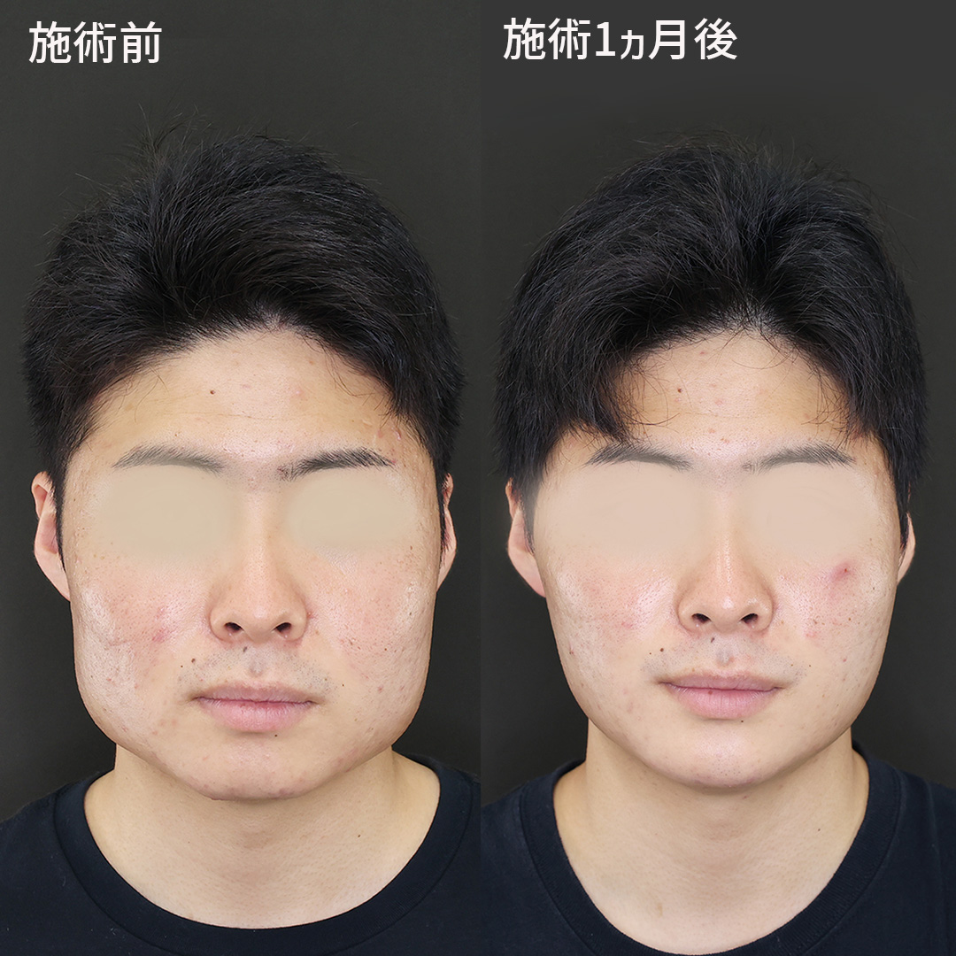 松本流小顔術で男性も垢抜け！【エラのボトックス注射】